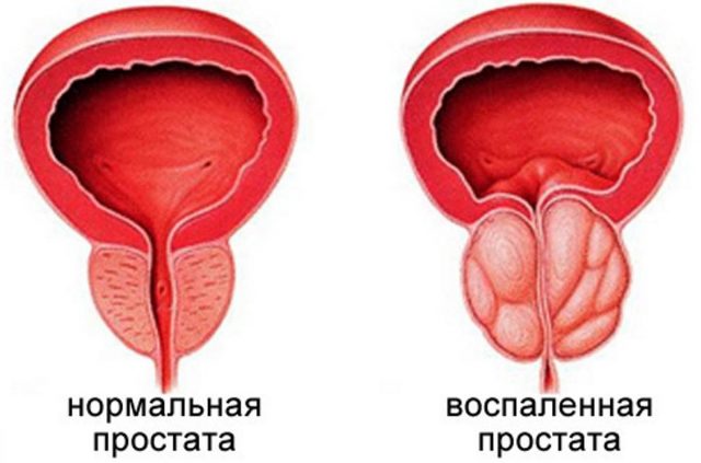 Пчелиный подмор: лечение аденомы простаты