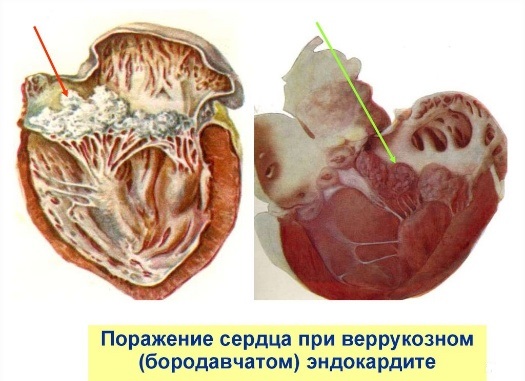 Возбудитель Рожи свиней